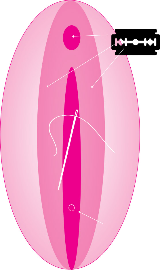 Vorhaut entfernen klitoris Klitorisvorhautreduktion bzw.